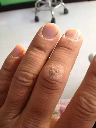 一年四季总裂手,摸了药膏也不好