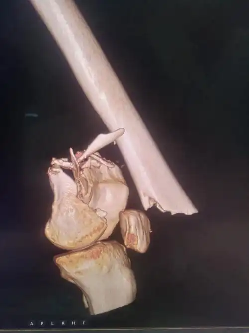 股骨远端开放性粉碎性骨折