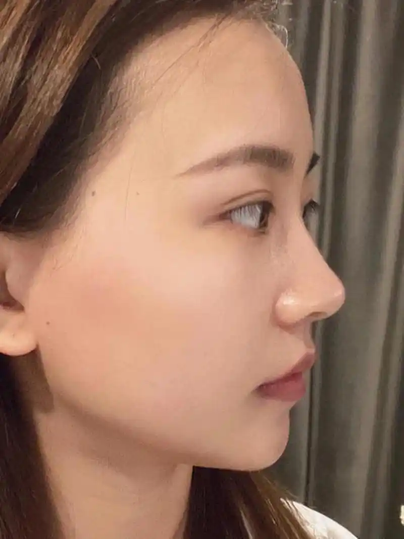 整容鼻子有五种鼻型,分别是:直鼻,盒鼻,翘鼻,微翘鼻和希腊鼻.