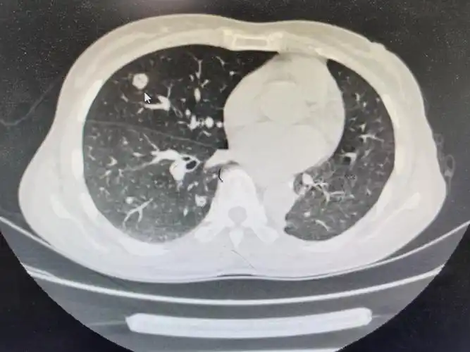 图文教你看懂恶性肺结节的ct表现
