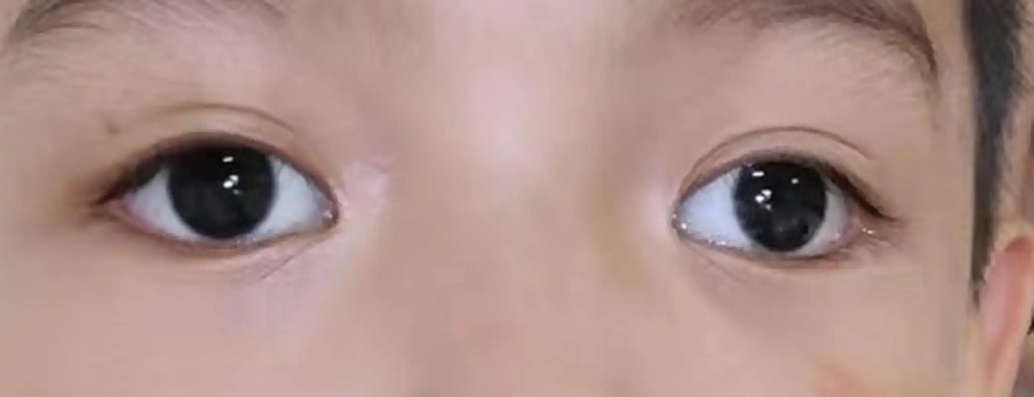 "医生,我小孩的眼睛看上去像斗鸡眼一样,是怎么回事""医生,为什梦我