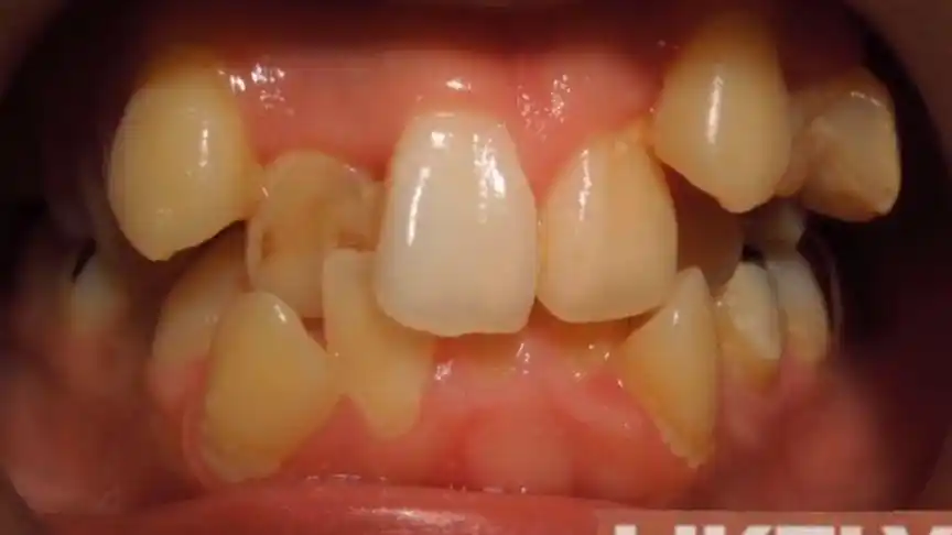 这一口参差不齐的牙齿历时三年多,终于