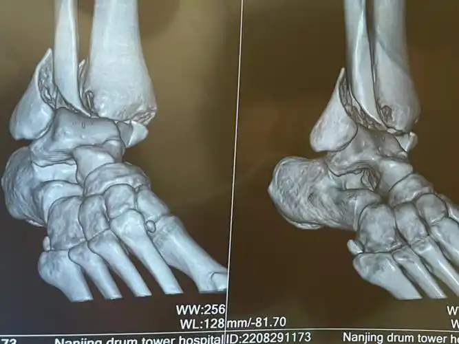 三踝骨折日记术前拍片