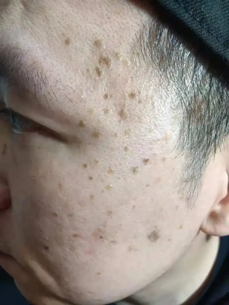 这些都是扁平疣案例.