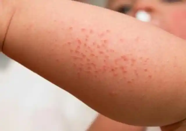 宝宝一到夏季就长湿疹牢记3点赶走湿疹不复发