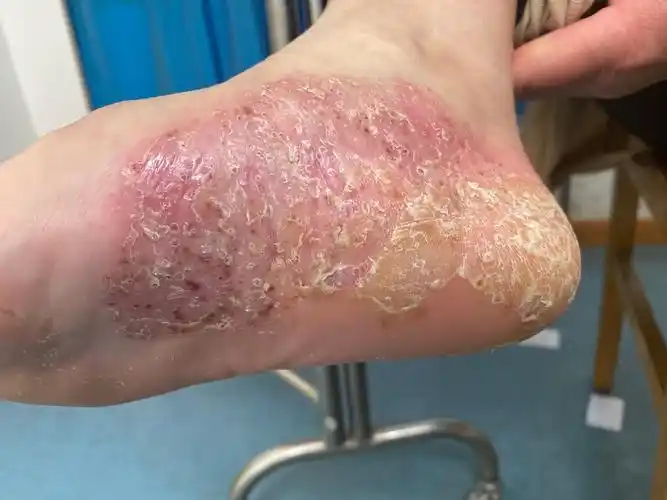 掌跖脓疱病临床治疗案例 - 好大夫在线