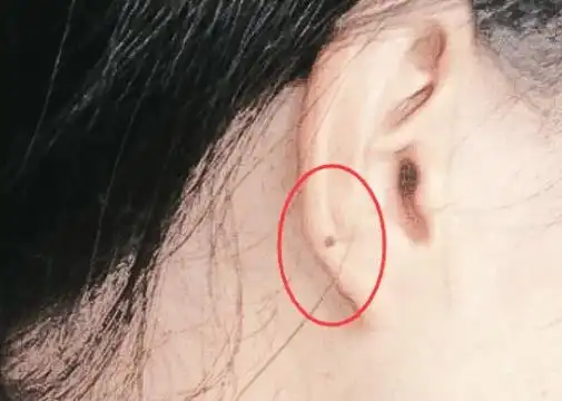 耳朵长痣的位置图解女寓意 女人耳朵长痣的位置与命运-祈福网