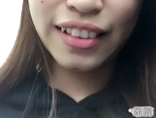 美然牙齿不齐骨性龅牙拔了8颗牙矫正3年半我终于从一个龅牙妹变成一个