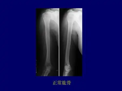骨骼x线诊断 正常肱骨