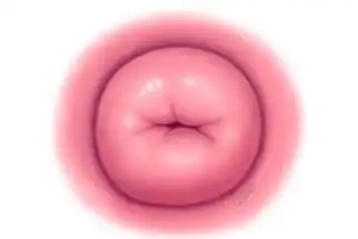 四个月引产后宫颈口图六个月引产后宫颈口的变化