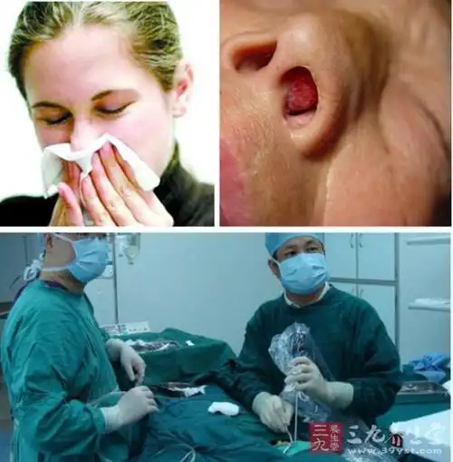 宝宝鼻息肉怎么引起的