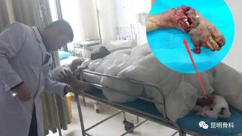 一家三口遭遇车祸昆骨专家连夜实施急诊手术