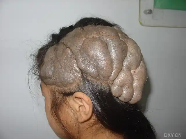 患者,女,8岁,出生时即被发现左侧头皮有一肿物,随年龄增长而增大,近2