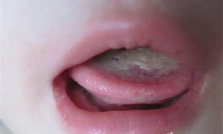宝宝舌苔厚白是怎么回事? 婴儿舌苔厚白怎么办?