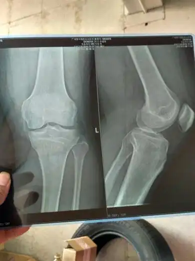 左胫骨平台髁间隆突见骨性小突起,帮忙解答一下