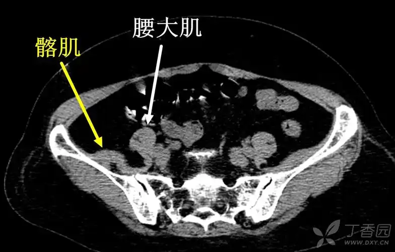 骨盆,臀部肌肉囊肿,一个盆腔,髋关节不适,疼痛的少见原因 [精华]
