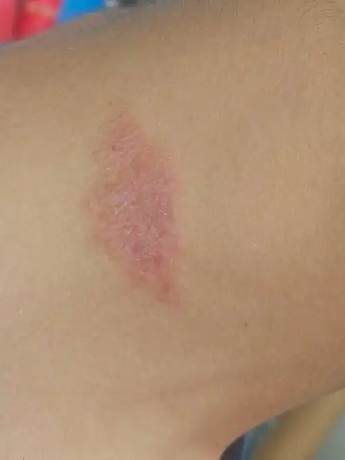 如果是请告诉我是什么癣?能否治好?谢谢!