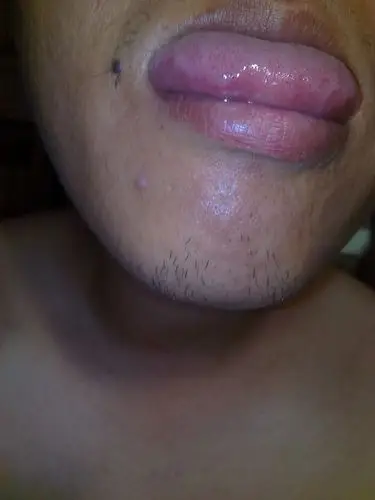 帮我看看我这是感染白念珠球菌症状谢谢医生