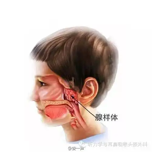 腺样体肥大的手术及相关科普