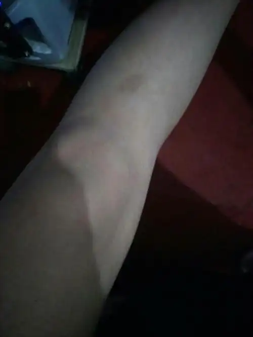 膝盖这里凹进去了,之前有点痛,走路不痛,就是跪的时候痛,现在好一些了