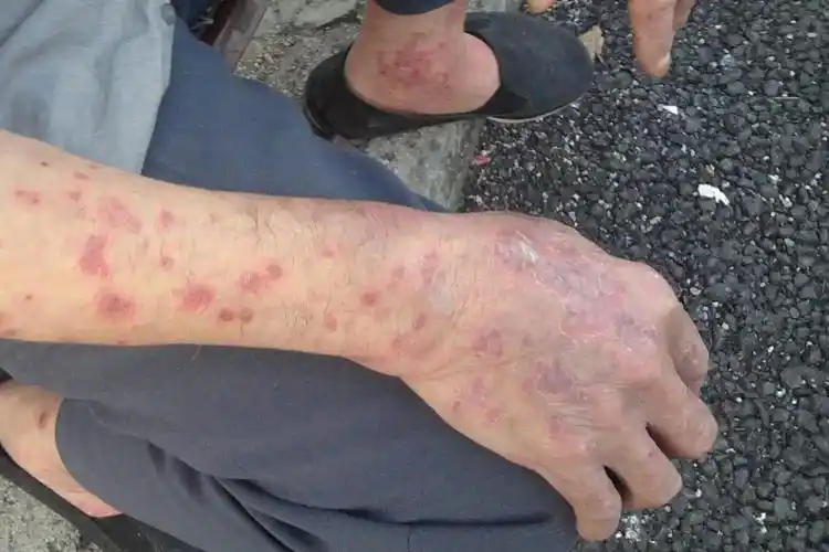 手上牛皮肤癣的症状图片_图文_文章_美咯_让您放心美!