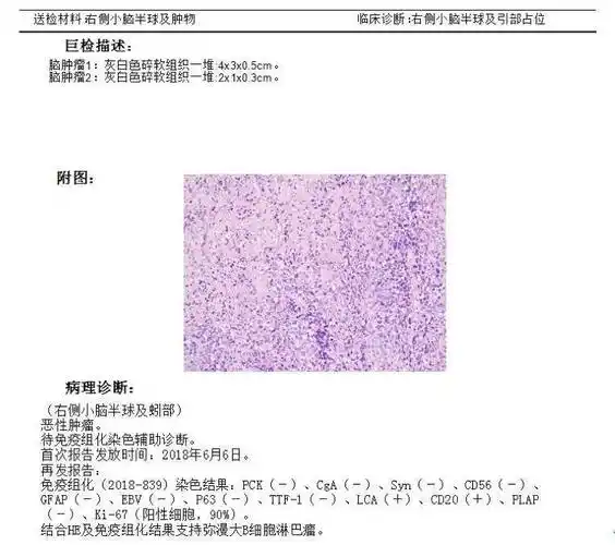 病理报告于 2018-06-04 日行「开颅右侧小脑半球及蚓部占位切除   去