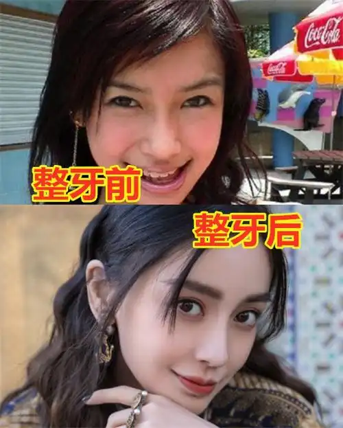 明星整牙前vs整牙后杨幂baby脸型变了而胡歌没有认出来