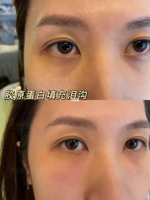 填充泪沟第一天的效果_泪沟_胶原蛋白_正佳广场攻略_胶原蛋白液_胶原