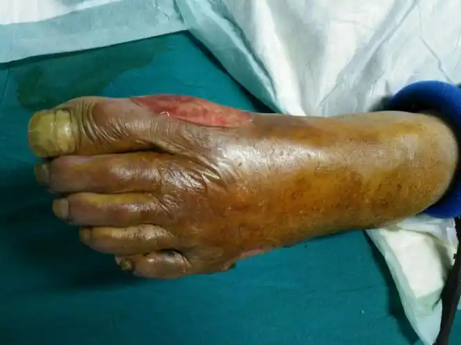 一例重度烧伤病例照片