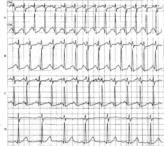 7-1 运动性窦性心动过速-精编心电图诊断-医学