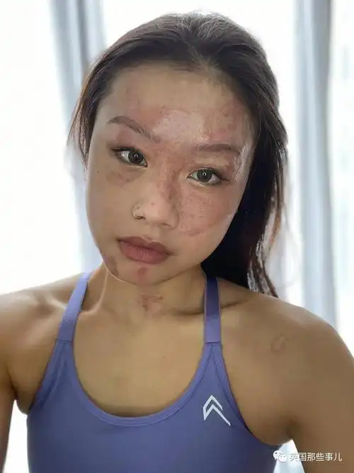 经过将近1年的恢复,现在她脸上的疤痕已经淡下去不少.