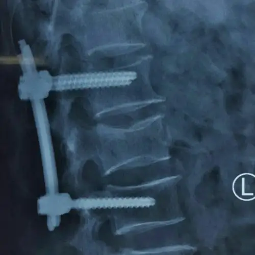 市一院骨六科完成经皮椎弓根钉棒内固定术治疗腰椎压缩性骨折一例