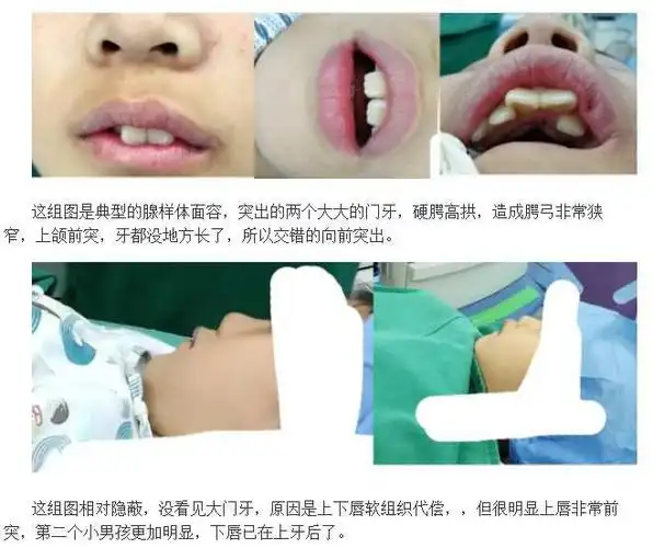 腺样体面容,如何矫正训练?(初期图片)
