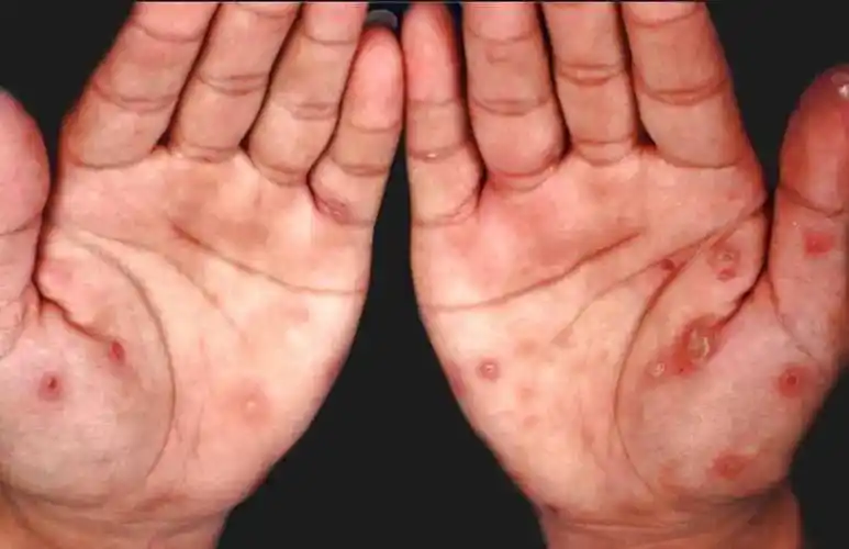 从没症状到痴呆,"梅毒三部曲"一定要看!_治疗_阳性_医生