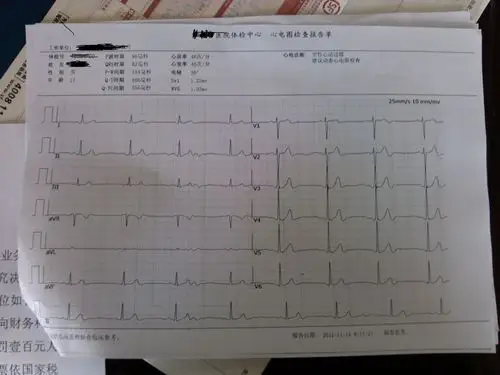 心电图要怎么看 ?窦性心动过缓,请大侠帮忙分析一下病情