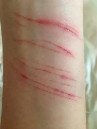 手用菜刀割开的需要打破伤风针吗?