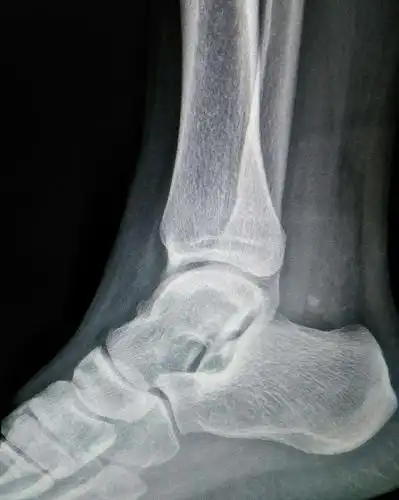 踝关节镜治疗后踝撞击综合征----距后三角骨损伤