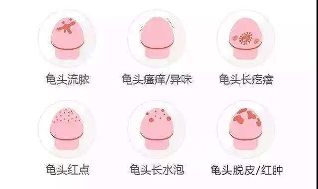 包皮龟头炎夏季高发期,包皮过长患者要注意_治疗