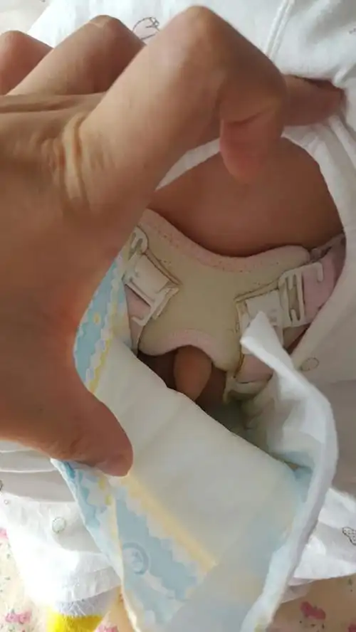 除了可以看到或摸到肿块之外,有些小孩会有便秘,食欲不振,吐奶等现象