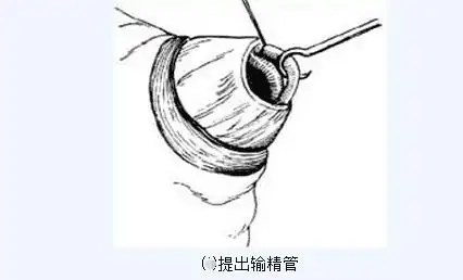 传说中的男性结扎手术全过程(附图), 做了真的会变成"太监"吗?