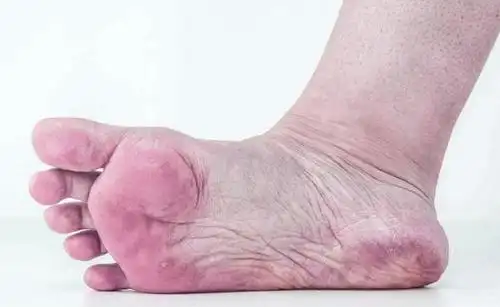 糖足病因及早期的症状