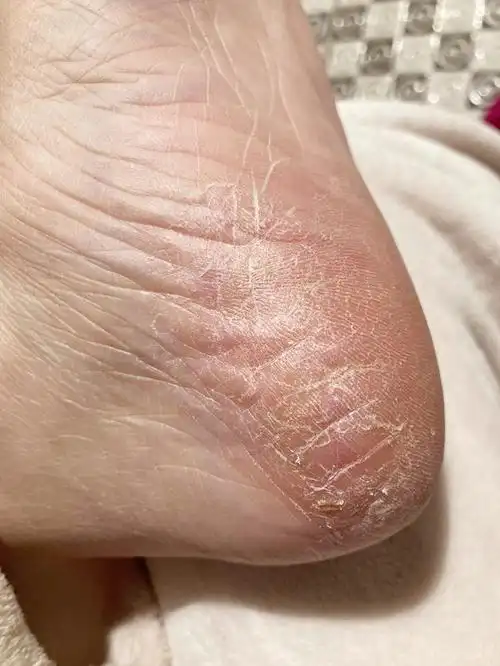 脚后跟皮肤粗糙开裂是什么原因?总是有死皮