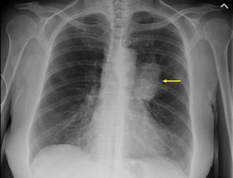 影像学中的肺癌分期上