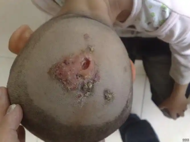 皮肤及性传播疾病讨论版 - 爱爱医医学论坛