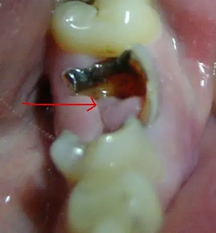 看来是你的牙龈组织长出来的息肉,到医院想办法处理一下,很小的手术