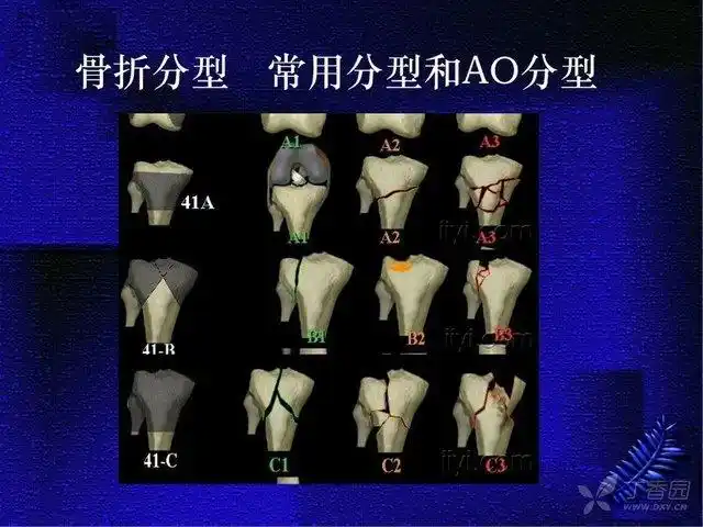 胫骨平台骨折分型及治疗