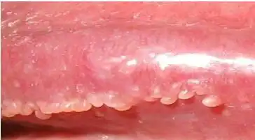 【冠状沟珍珠疹图片】_症状_注意事项_苹果绿