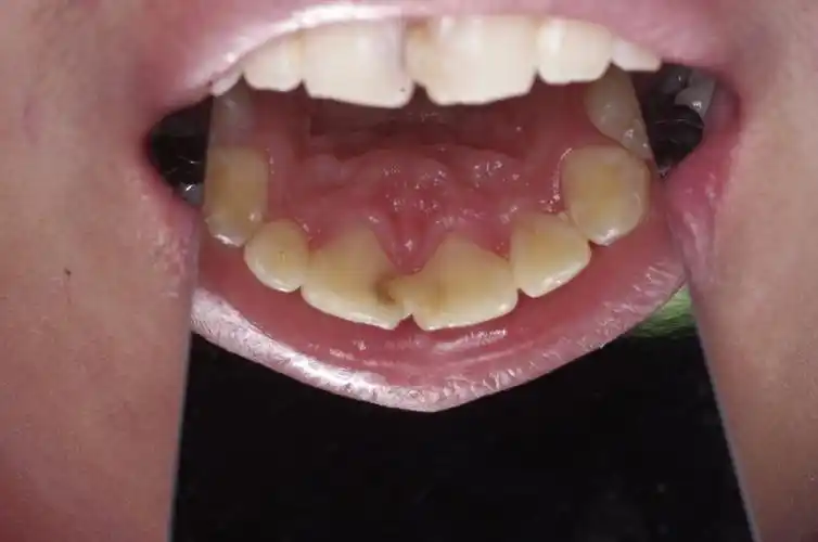 去除"隐患"——治疗邻面龋