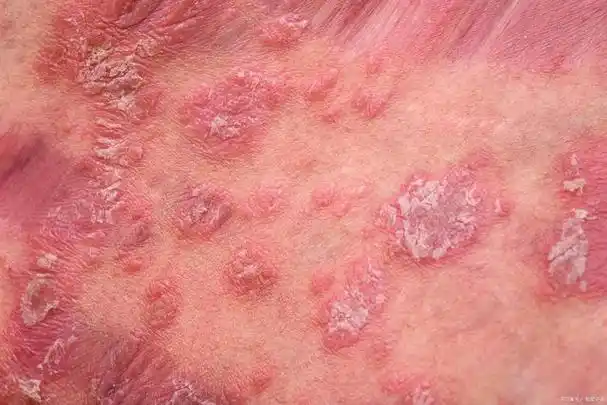 梅毒的潜伏期是多长如果人有这几种表现可能是感染了梅毒