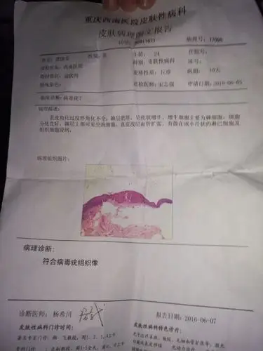 医生给的病理报告诊断说 符合病毒疣组织像,可我没有不洁性生活啊